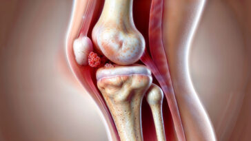 Gout In Knee